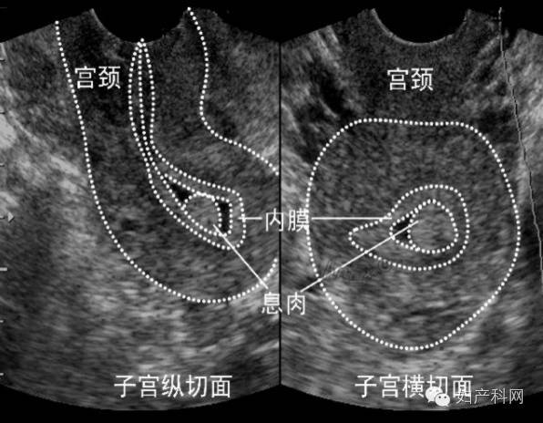 【妇产快报】子宫内膜息肉超声诊断大全