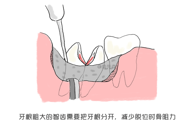 真的勇士敢于直面拔阻生智齿的人生