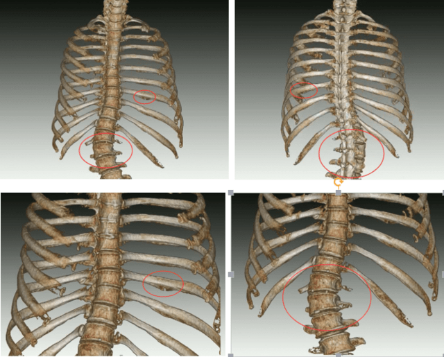 可以清楚地看到肋骨和脊椎的病变情况;左四肋骨发育畸形,长了鸟嘴形态