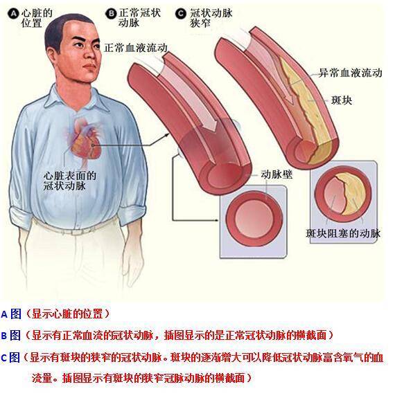 冠心病最爱找这些人麻烦了!