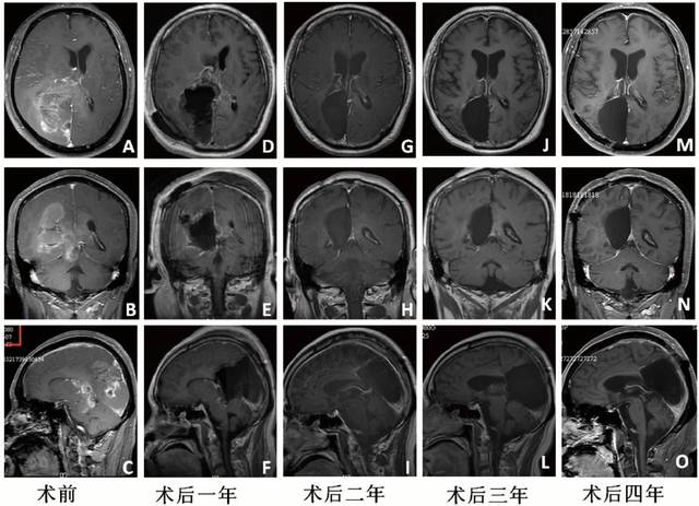 长期生存的胶质母细胞瘤患者的临床特点及异柠檬酸脱氢酶1/2基因突变