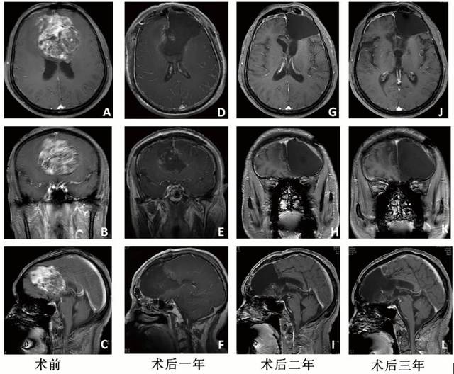 长期生存的胶质母细胞瘤患者的临床特点及异柠檬酸脱氢酶1/2基因突变