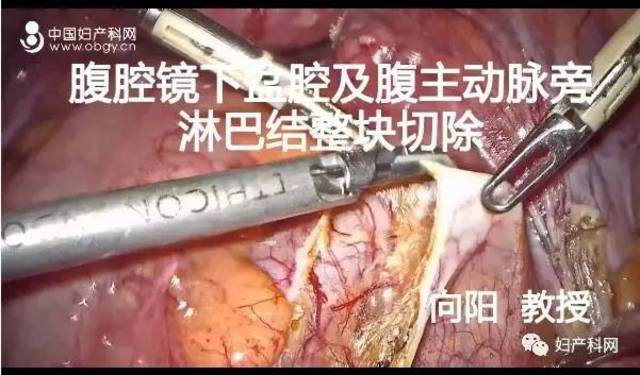 80 向阳教授:腹腔镜下盆腔及腹主动脉旁淋巴结整块切除