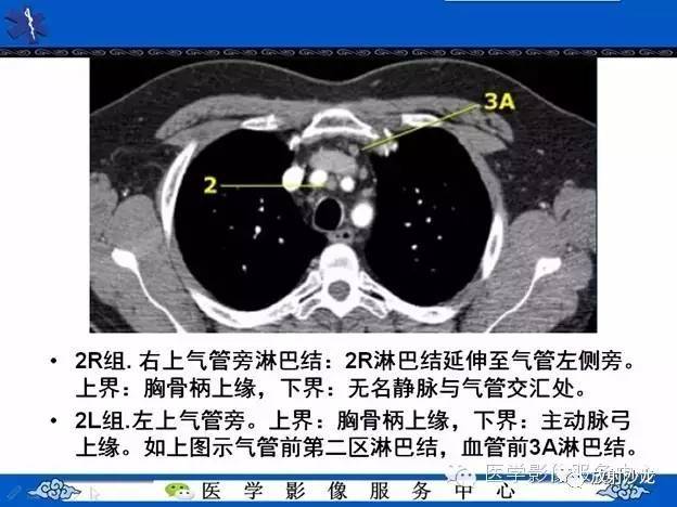 从常见部位看:在ct诊断中如何发现纵隔淋巴结增大