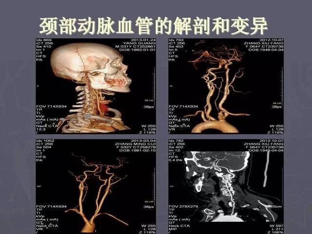 介入医学课件│颈部血管cta成像的临床应用