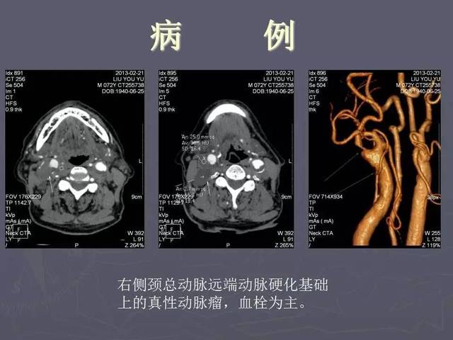 介入医学课件│颈部血管cta成像的临床应用