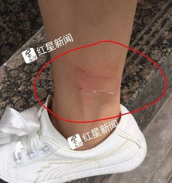 龙女士被狗咬后的印痕