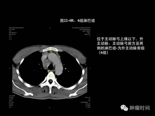 经典中的经典:胸部 ct 断层,肺叶分段,各组淋巴结划分