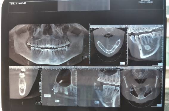 牙齿的整体排列,牙槽骨情况,医生以此更清楚的了解到整个口腔健康状况