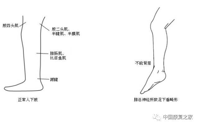 足下垂步态