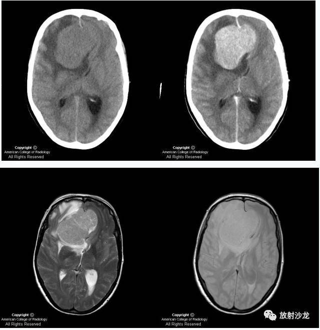 嗅沟脑膜瘤(olfactory meningioma)mri-ct病例影像诊断分析