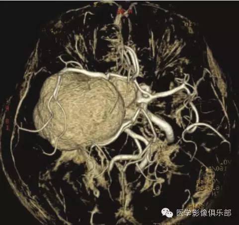 颅内脑外海绵状血管瘤