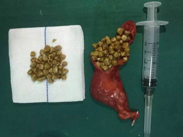 玉兰·新技术 | 胆管内掉入47枚结石引发胆源性胰腺炎 微创手术去除