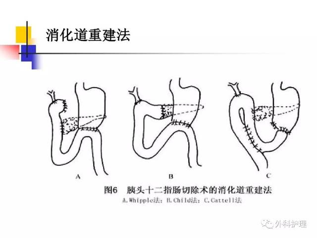 胰十二指肠切除手术护理查房