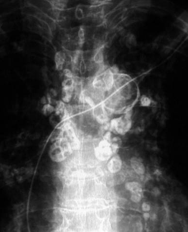 肺部错构瘤图片