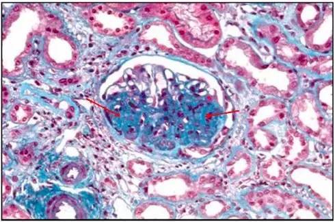 肾内病理图解:遗传性肾病