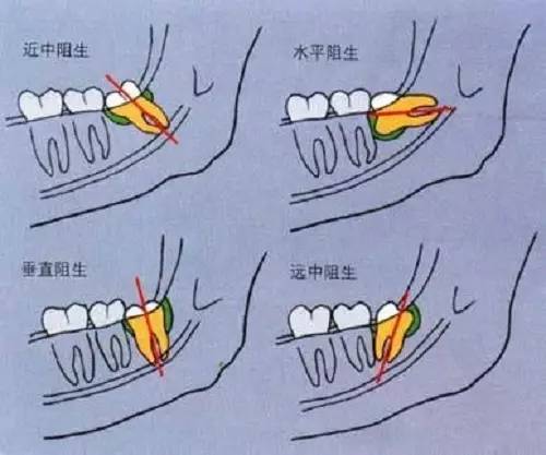 阻生智齿的几种常见类型 口说无凭,上病例.来看下面这例