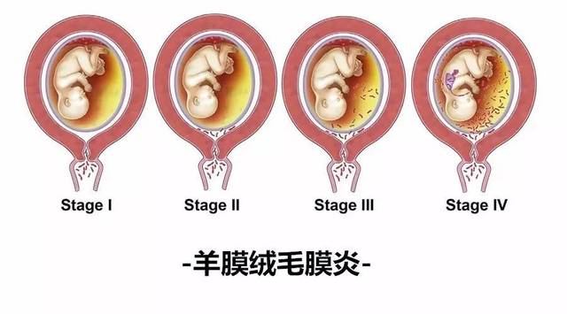 孕晚期要当心胎膜早破!