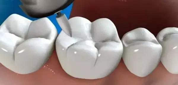 充填材料与天然牙紧密相连,一颗完整的牙又回来了 调磨