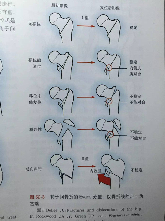 股骨转子间骨折evans分型到底应该怎么分