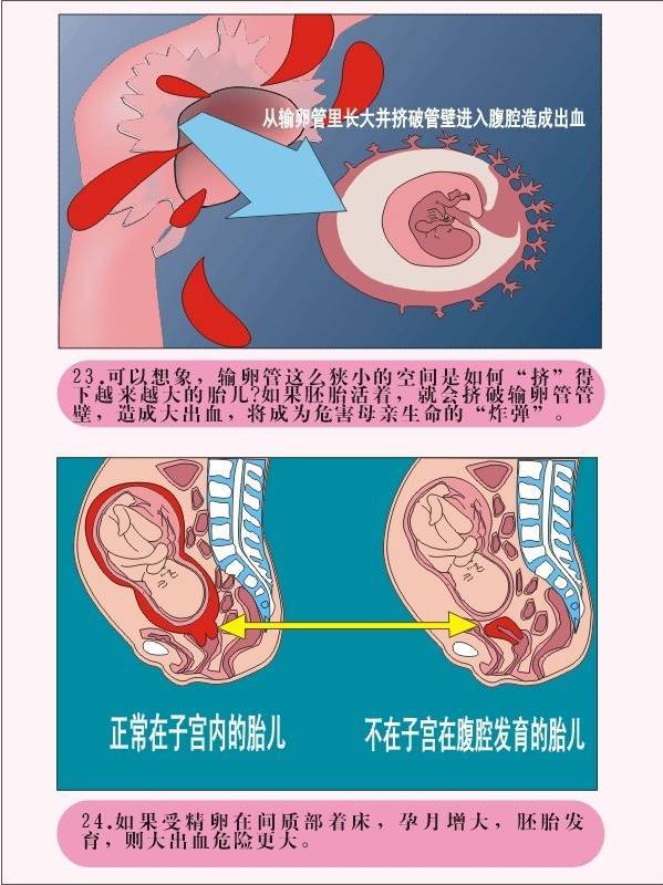 图解疾病 宫外孕