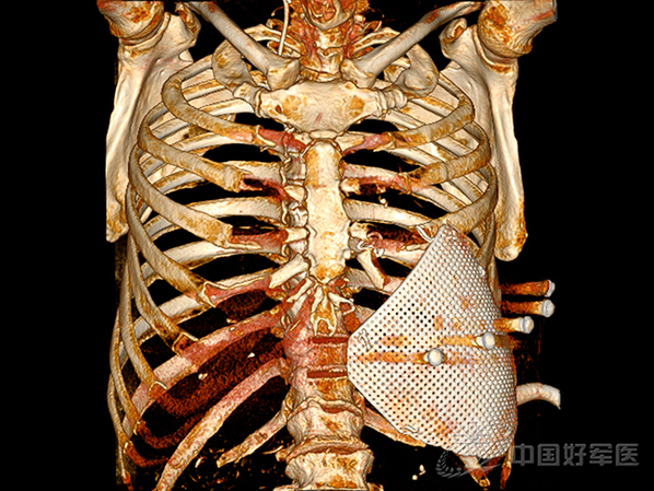 装置3d适形钛板胸壁成形术后的ct三维重建图像