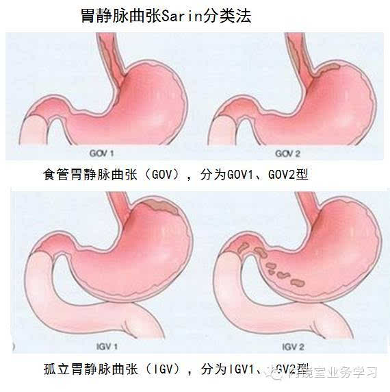 2016年版食管胃静脉曲张指南学习