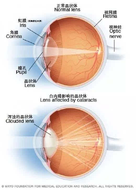 浑浊的晶状体阻碍了光线进入视网膜,从而导致明显的视力下降.