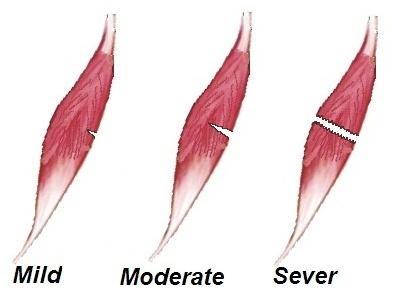 指肌肉-肌腱单元的微小损伤,典型者肌肉或肌腱纤维的撕裂小于5%