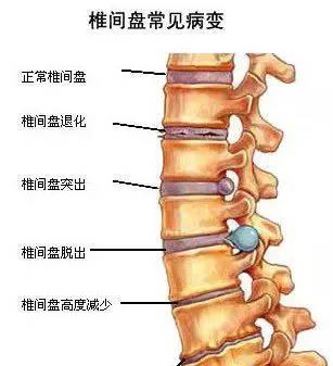 严重的腰椎间盘突出让他不能正常行走,每走上一两步