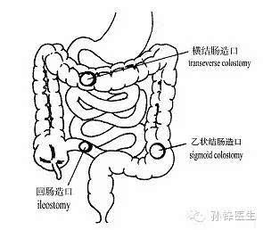 精品原创|医生,您为什么要让我"挂粪袋"?