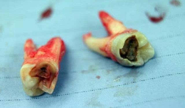 孩子的牙齿严重腐烂,医生必须将他全身麻醉,才可以拔除他的11颗坏牙