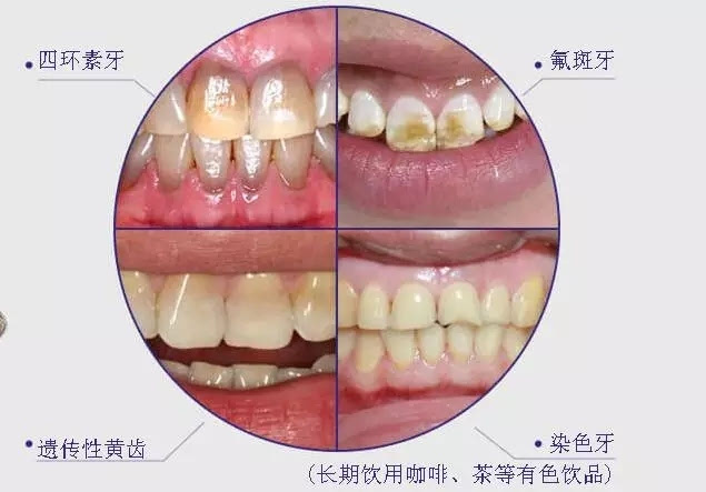 四环素牙,氟斑牙,遗传性黄齿,染色牙 冷光美白效果