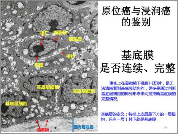 这里提醒一下,有很多人误认为浸润癌指的是黏膜下浸润癌,事实上,在