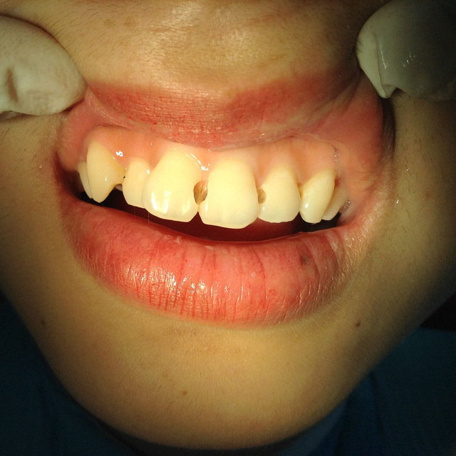 案例分享:牙齿龋坏治疗