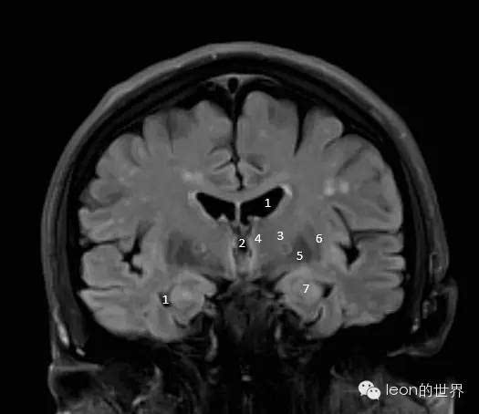 1侧脑室2三脑室3内囊4丘脑5豆状核6屏状核7杏仁核