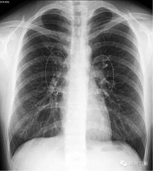 正常情况双肺下野肺纹理较肺上野明显,肺野内带肺纹理明显,外带肺纹理