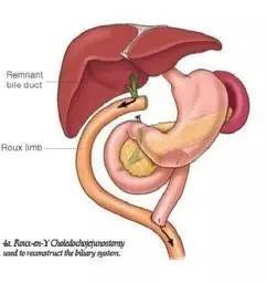 胆肠吻合术后吻合口狭窄?先问自己这5个问题!