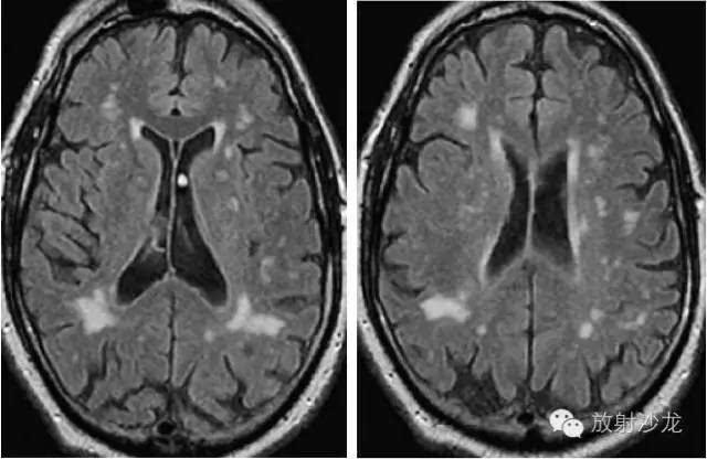 脑白质病变的影像学鉴别诊断