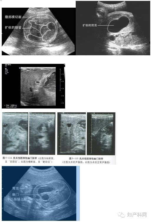 08超声诊断胎儿消化系统畸形(图)