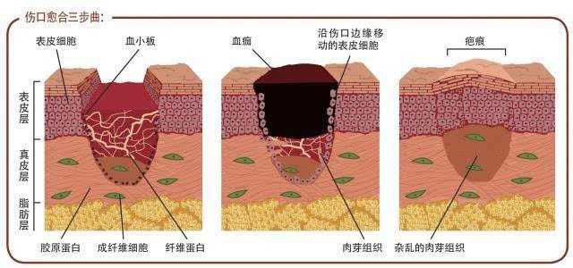 以皮肤伤口举例来说,其愈合可以大致分为以下几个阶段