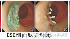 一文读懂|消化内镜钛夹(止血夹)的应用!