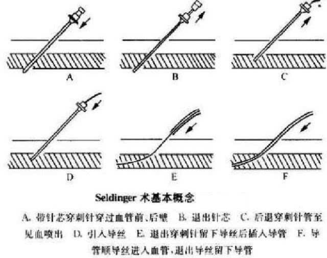 改良seldinger股动脉穿刺技术 1974年由 driscoll提出, 该法不穿透股