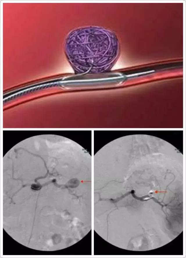 脾动脉腔内隔绝术以及弹簧栓塞术(伴/不伴裸支架辅助)治疗脾动脉瘤