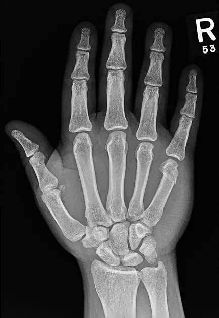 请问:左手食指远节指骨骨折,在工伤伤残评级中能评到几级? 谢谢!