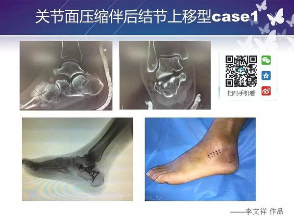 手术技术:跗骨窦切口治疗跟骨骨折