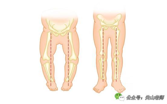 你家宝宝也"o型腿"了吗?可能只是你太担心了!