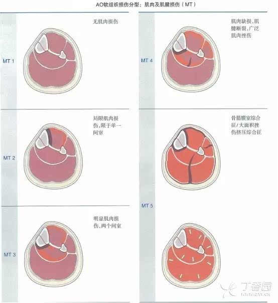 在 gustilo 分型中,神经血管损伤(图 9)被认为是最严重的损伤并有很高