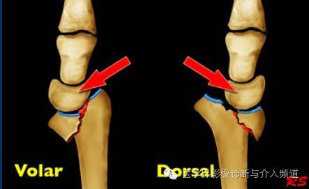 一个特殊骨折引出的一系列骨折学习!