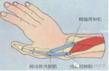 而内侧(与小指同侧)则是手指及手腕屈肌肌腱附着处,外侧的肌腱发炎